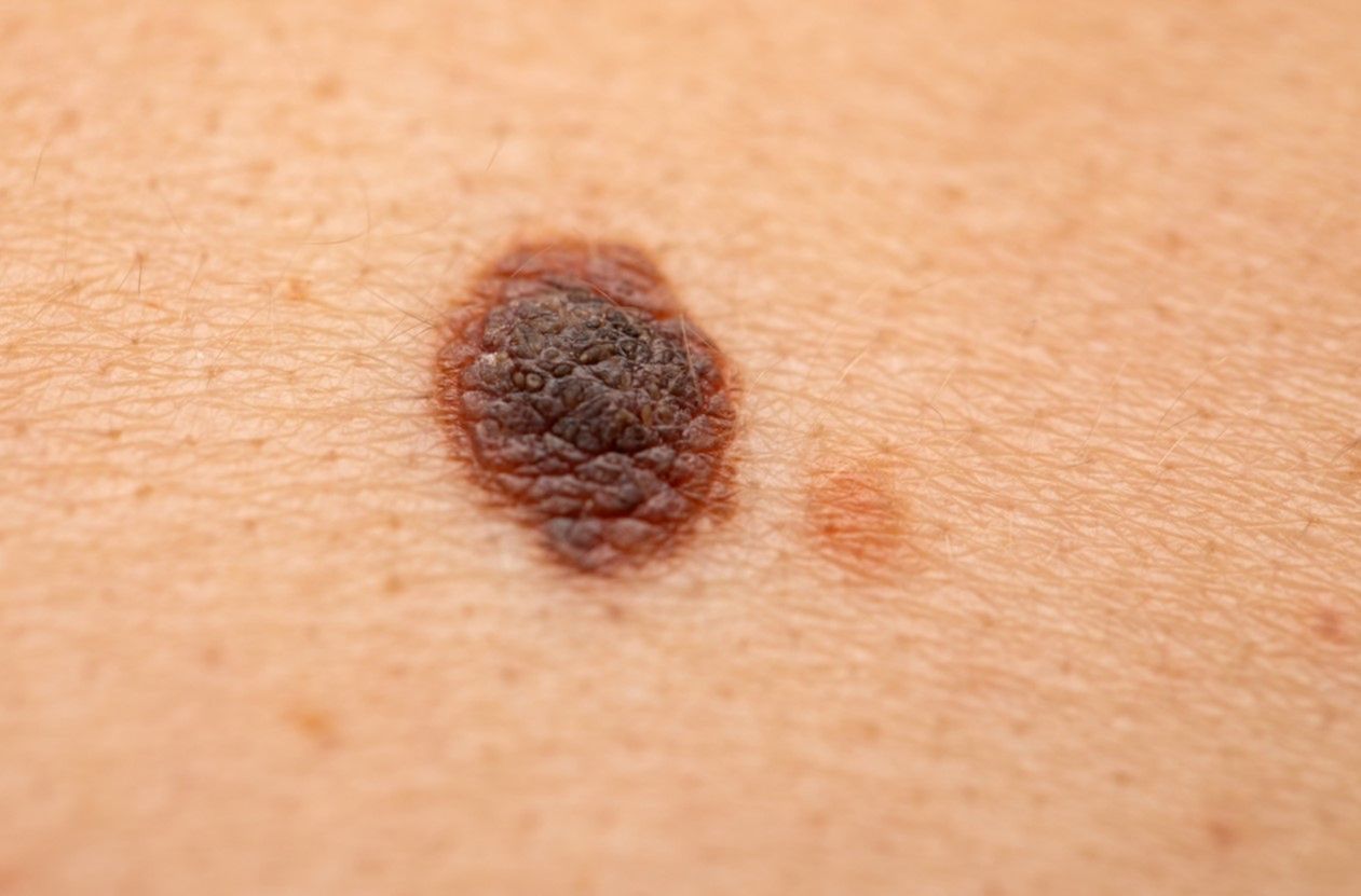 Usuwanie pieprzyków za pomocą tradycyjnych i innowacyjnych metod.  Chirurgia, krioterapia, laseroterapia, elektrokoagulacja | WP abcZdrowie