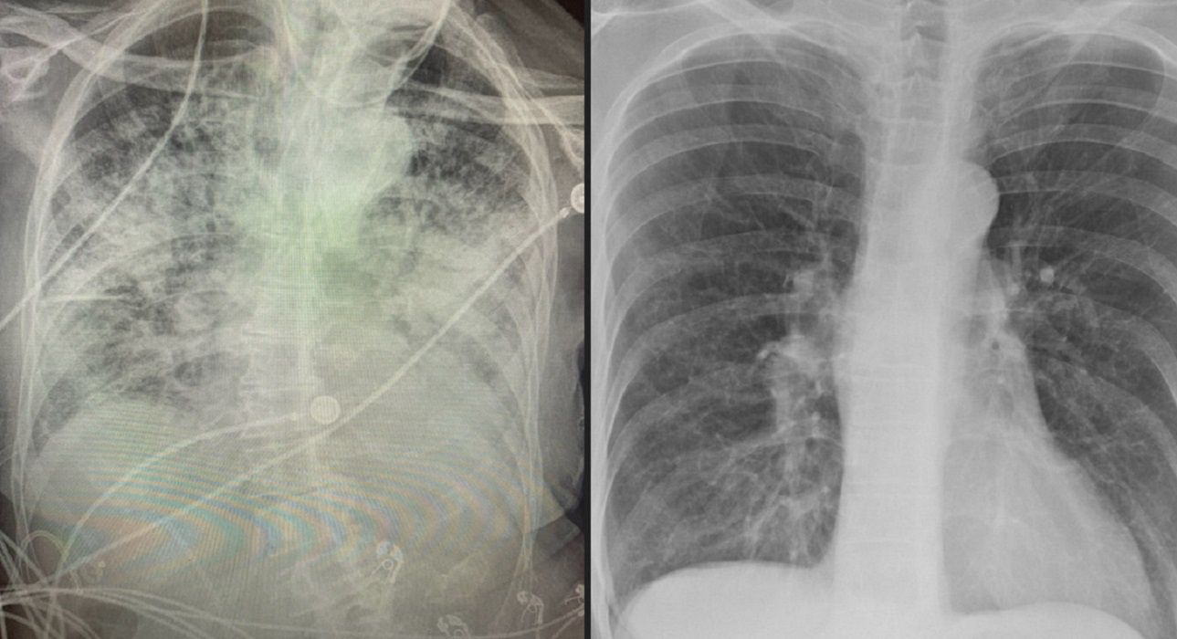 Pluca Palacza Vs Zdrowe Pluca