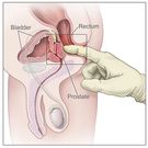 Per rectum - zdjęcie