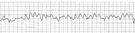 Wyniki badania EKG z diagnozą migotania komór