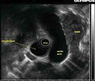 Ultrasonografia transkawitalna