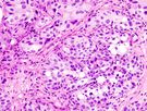 Obraz histologiczny raka pęcherza moczowego