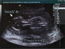 Rozwój płodu - 17 tydzień