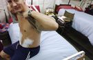 Koronawirus może niszczyć nerki. "Ostra niewydolność nerek może dotyczyć do 10 proc. pacjentów, którzy chorują na COVID-19"