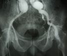 Angiografia tętniaków w obszarze biodra