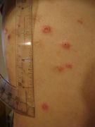 Rumień guzowaty (Erythema nodosum)