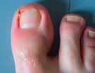 Zanokcica stopy