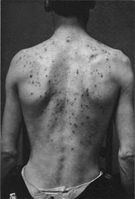 Trądzik młodzieńczy (acne juvenilis)
