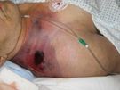 Pacjent zakażony bakterią Clostridium perfringens
