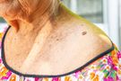 Dermatofibroma - przyczyny, objawy, leczenie