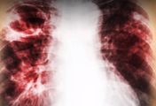 Epidemia gruźlicy na Ukrainie. Czy mamy się czego obawiać? (WIDEO)
