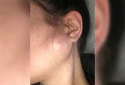 Zmiana na policzku okazała się objawem raka (WIDEO)