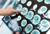 Poprawiają pamięć i koncentację. 6 produktów, które chronią przed chorobą Alzheimera