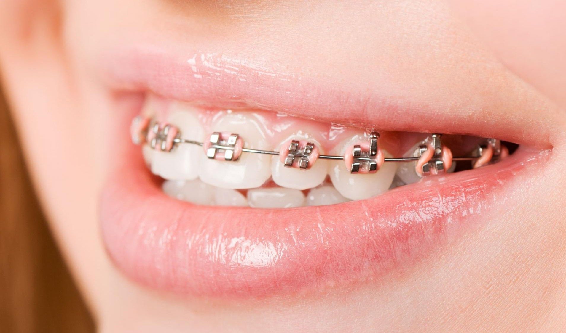 Retainer to sposób na wyeliminowanie wad zgryzu u dzieci i osób dorosłych