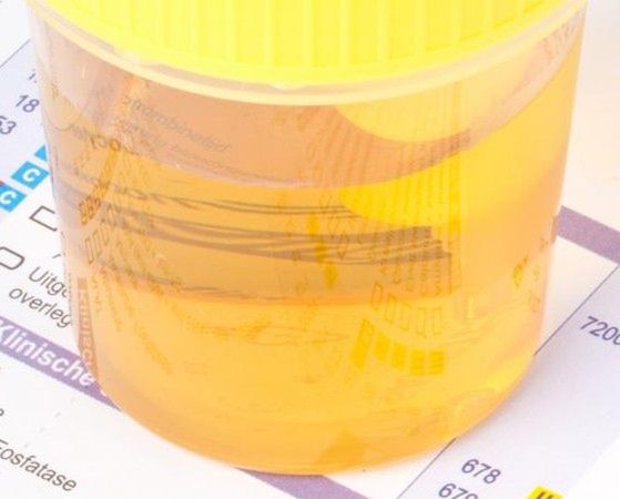 Ciemny mocz może być sygnałem, że organizm został zainfekowany
