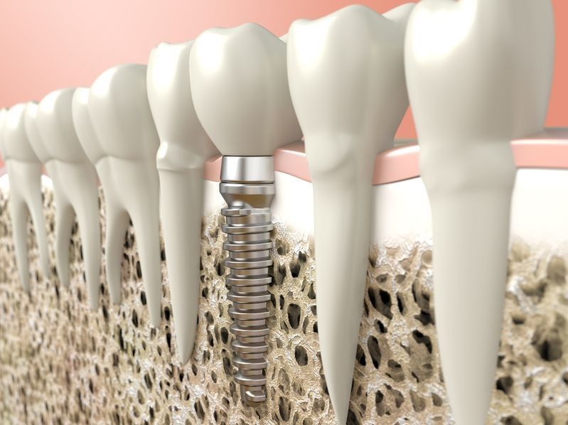 Naukowcy pracują nad nową generacją implantów