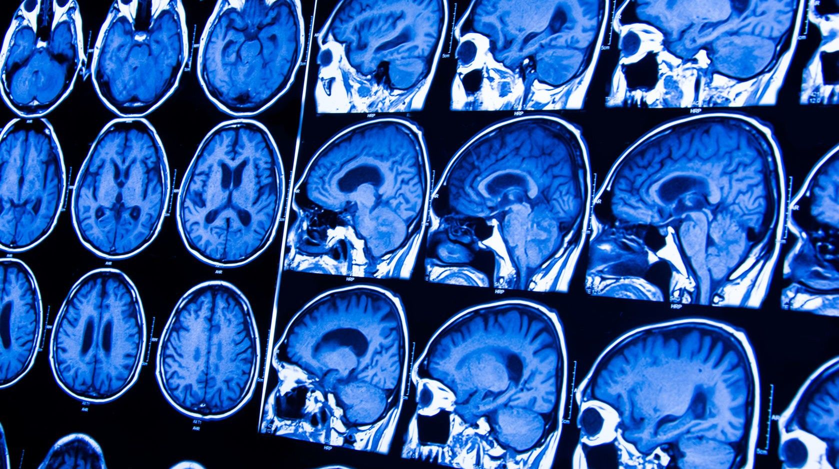 Wylew może powodować zaburzenia neurologiczne