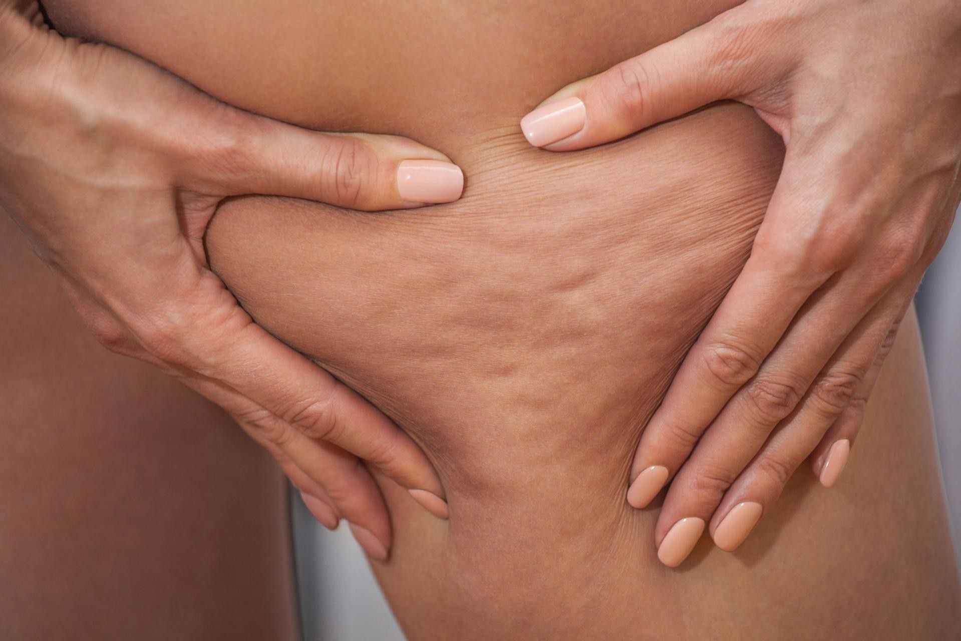 Ciężkość i obrzęk nóg może wynikać z choroby zwanej lipodemią