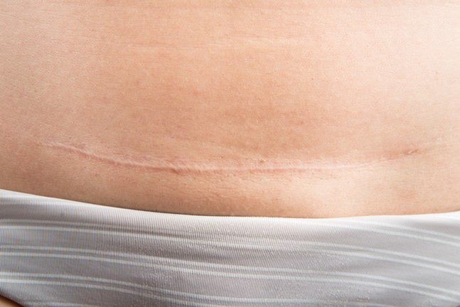 Podczas cesarskiego cięcia najczęściej obecnie stosuje się cięcie poprzeczne