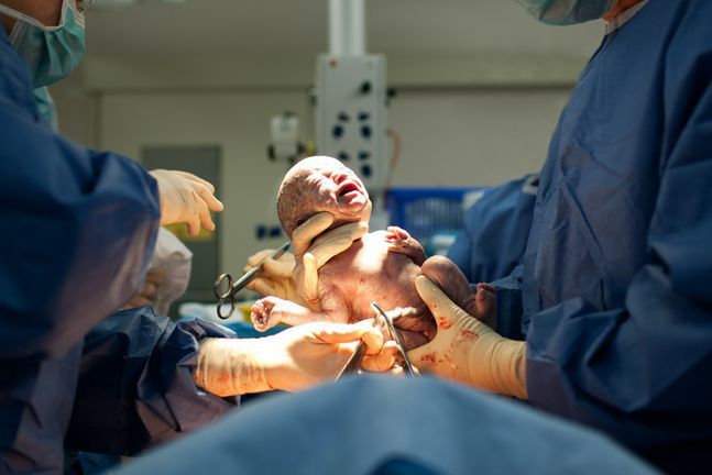 Coraz więcej Polek decyduje się na cesarskie cięcie, swój wybór tłumacząc zmniejszonym ryzykiem powikłań okołoporodowych, takich jak niedotlenienie dziecka