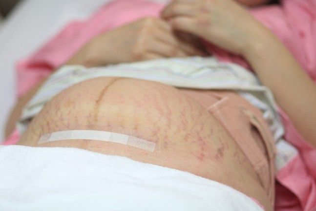 Obecnie podczas cesarskiego cięcia praktykuje się wykonanie poziomego nacięcia w dole brzucha przyszłej mamy. Dzięki temu, po zagojeniu się, blizna jest mniej widoczna