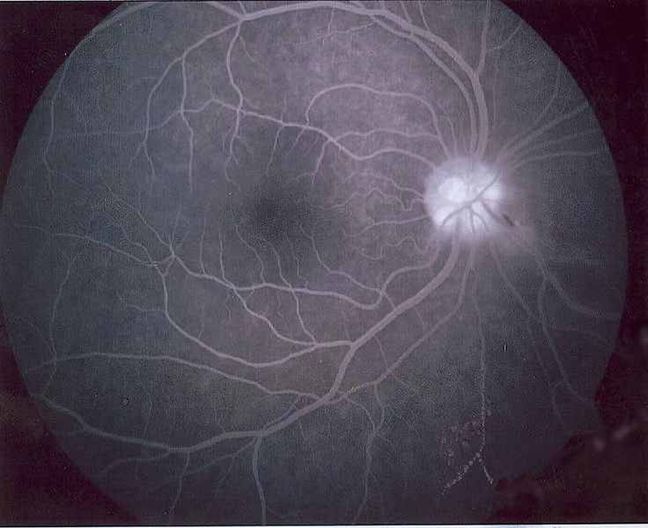 Angiografia oka