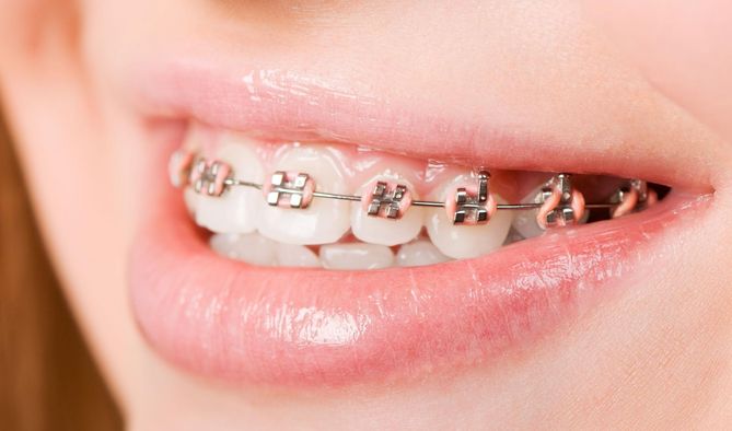 Retainer to sposób na wyeliminowanie wad zgryzu u dzieci i osób dorosłych