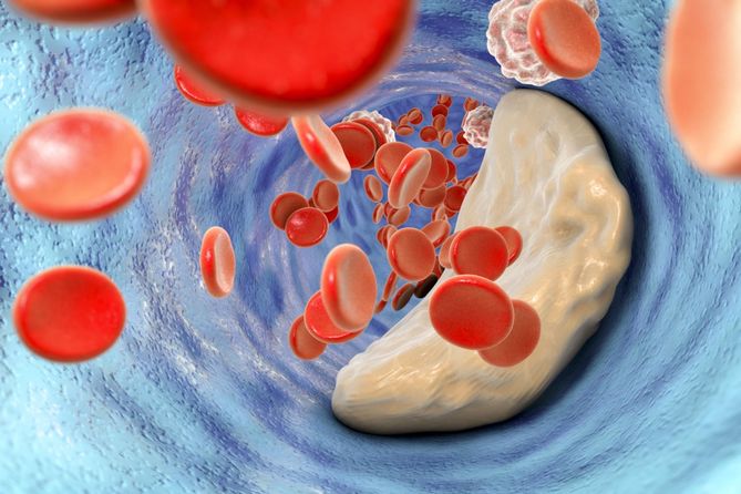 Hiperlipidemia zwiększa ryzyko pojawienia się miażdżycy.