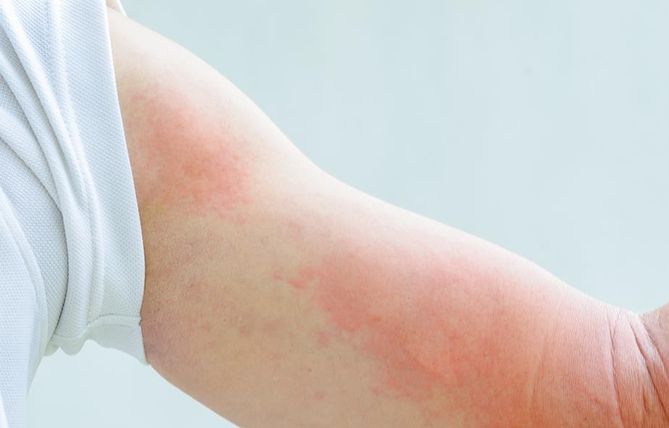 Czerwone plamy na ciele mogą być objawem alergii, ale także świerzbu, szkarlatyny czy enterowirusa.