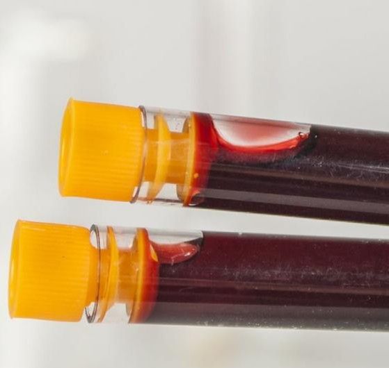 Sferocytoza to inaczej anemia hemolityczna