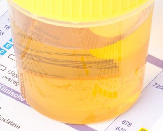 Ciemny mocz może być sygnałem, że organizm został zainfekowany