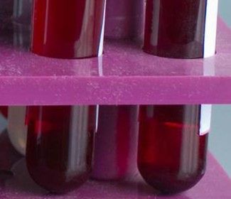 Neurofibromatoza jest diagnozowana między innymi na podstawie badania krwi