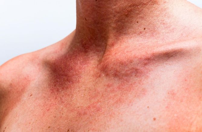 Plamica alergiczna tworzy stan zapalny.