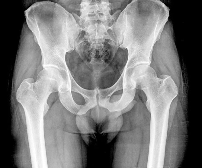 Osteoporoza to zaburzenie mikroarchitektury kości