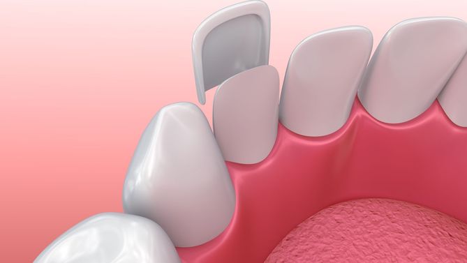 Najczęściej stosuje się w stomatologii nakładki porcelanowe