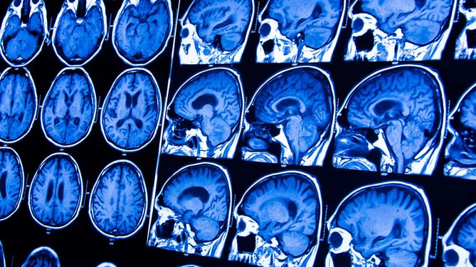 Wylew może powodować zaburzenia neurologiczne