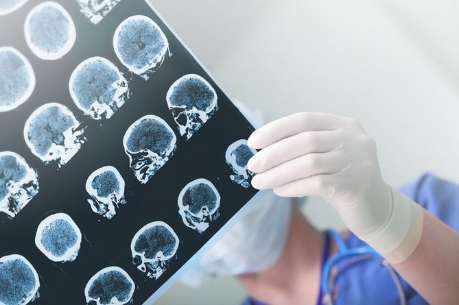 Jedną z przyczyn afazji może być udar mózgu