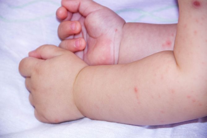 Nieleczona choroba bostońska może doprowadzić do poważnych powikłań