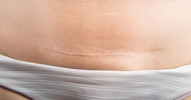 Ćwiczenia po cesarskim cięciu można zacząć do 12 tygodniu po porodzie