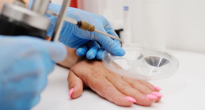 Brodawka łojotokowa nie jest zmianą nowotworową może być usunięta np. zabiegiem krioterapii