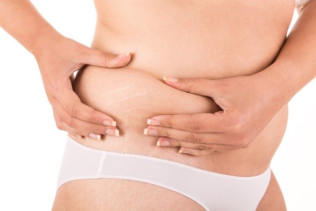 Rozstępy w ciąży powstają na skutek uszkodzenia włókien skórnych