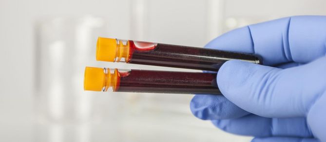 By zdiagnozować insulinooporność, wykonuje się badanie krzywej cukrzycowej