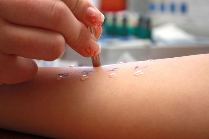 Testy skórne przeprowadzane są w celu wykrycia alergii