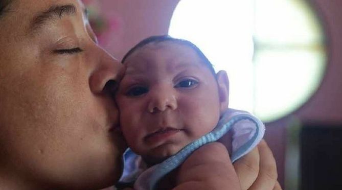 Dziecko z mikrocefalią, spowodowaną wirusem Zika
