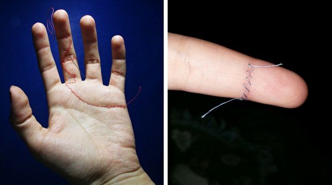 Skin stitching - nowe wyzwanie wśród nastolatków