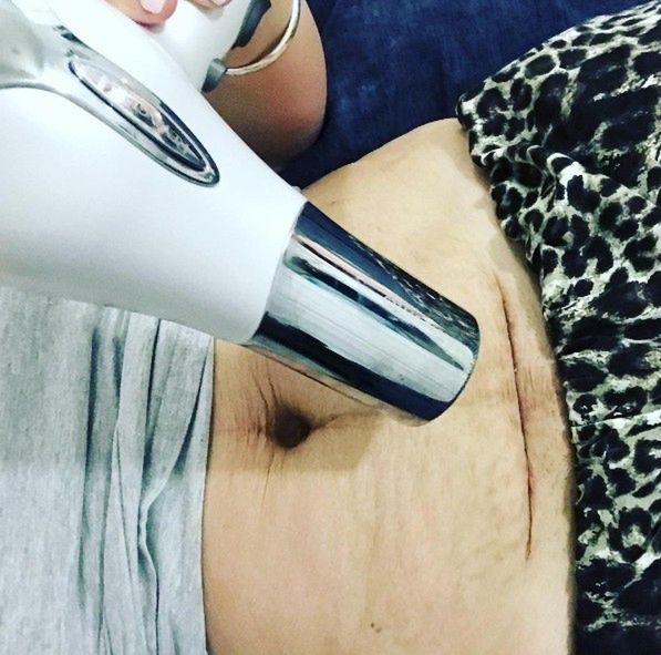 Blogerka otwarcie mówi o swoim stanie po cesarskim cięciu