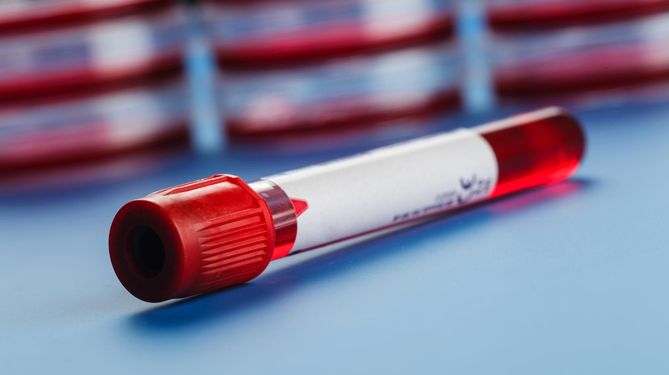 Poziom TSH da nam odpowiedź na temat nieprawidłowości w pracy tarczycy