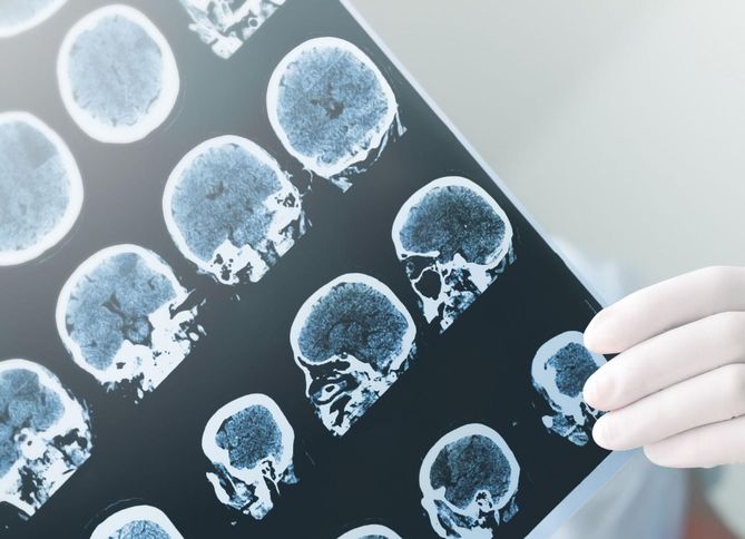 Objawy udaru mózgu muszą być poparte specjalistycznymi badaniami