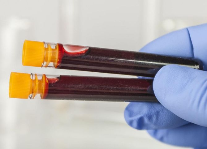 Podwyższone CRP jest określone na podstawie morfologii z rozmazem