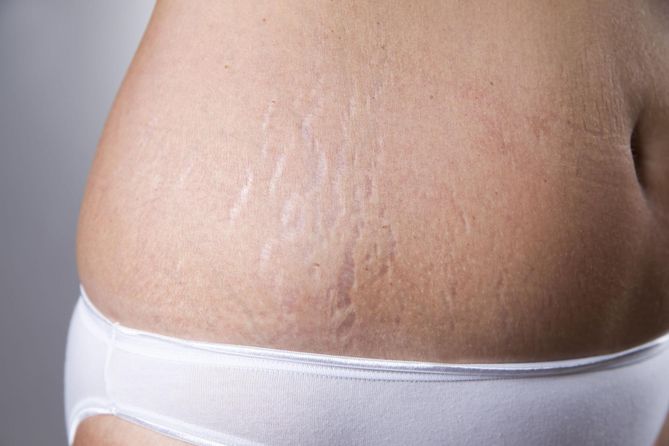 By nie wystąpiły rozstępy po ciąży, ważna jest dieta, odpowiednie nawodnienie i kosmetyki
